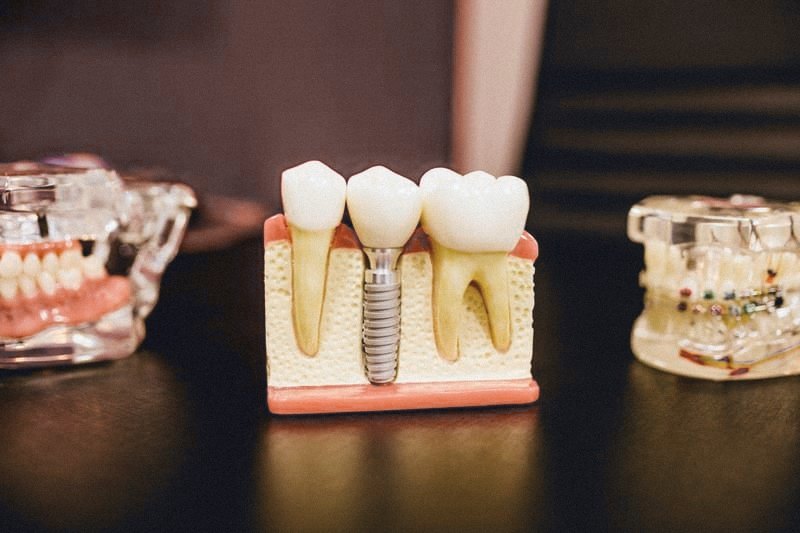 Dental models showing crowns and an implant