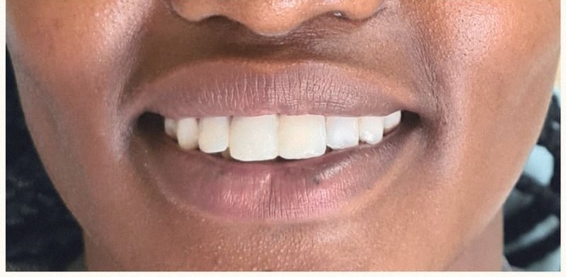 Smile after cosmetic treatment