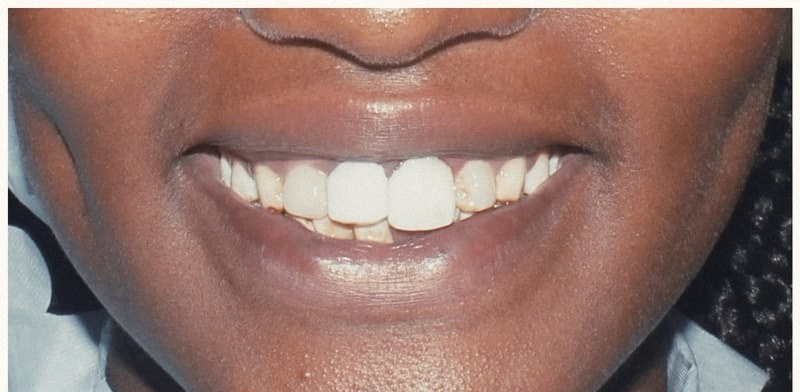Smile before cosmetic treatment