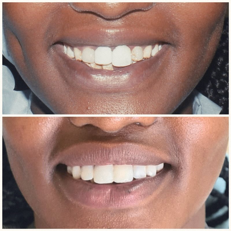A smile before (top) and after (bottom) cosmetic treatment